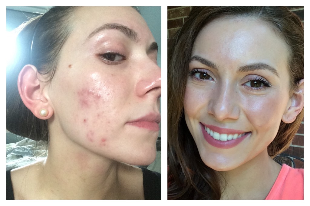 10 Ways To Get Rid Of Hormonal Acne Fast And Naturally Howhunter