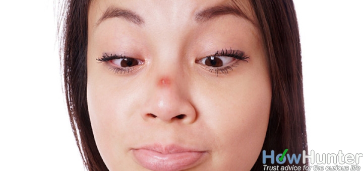 10 ways to get rid of whiteheads on nose and chin fast naturally