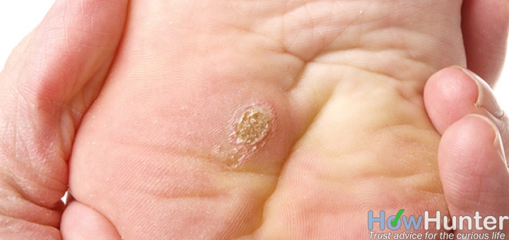 10 ways to get rid of warts fast and naturally