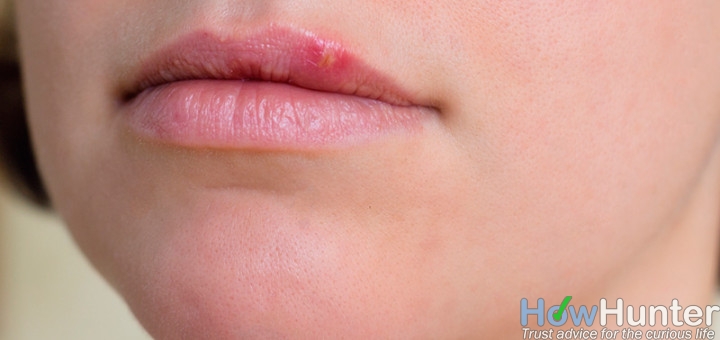 how to get rid of cold sores