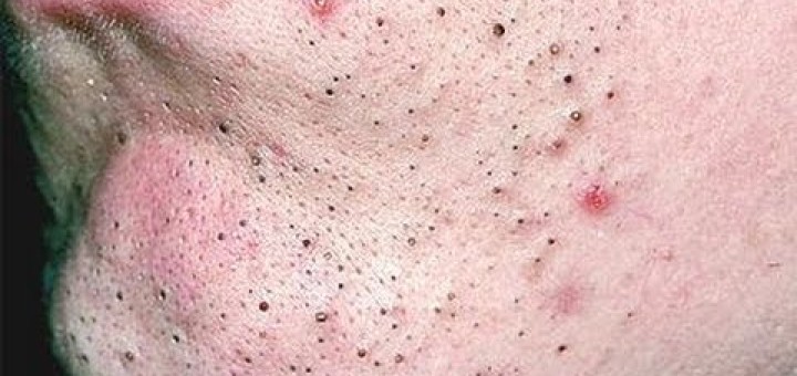 remove deep blackheads on chin