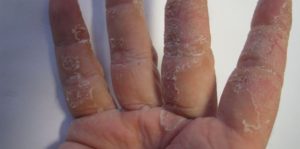 10 Ways to Get Rid Of Extremely Dry Skin on Hands - HowHunter