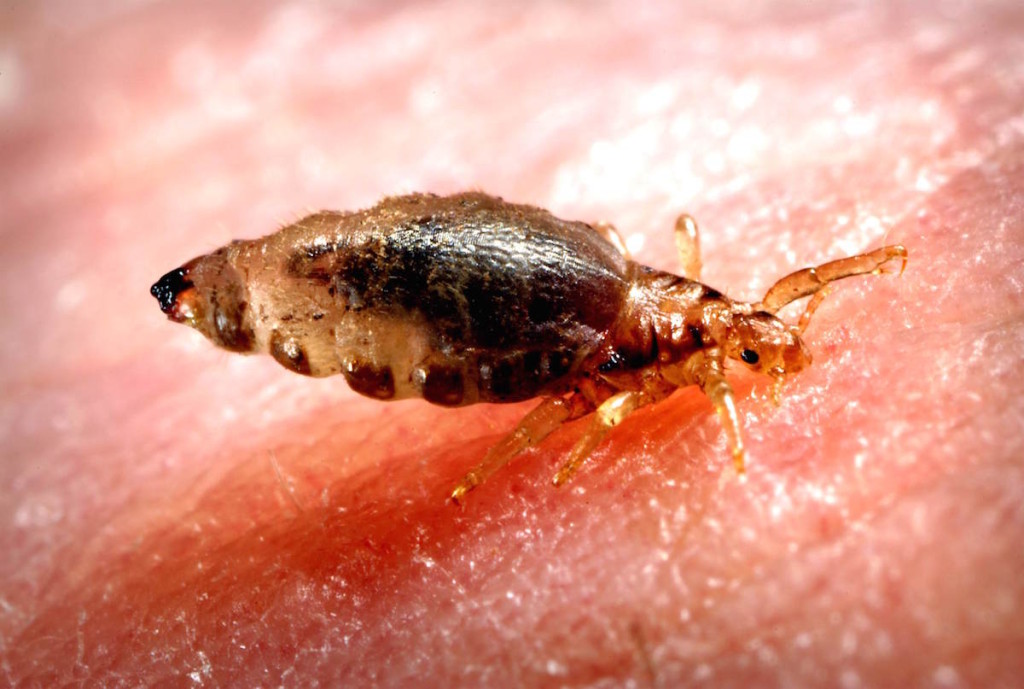 10-ways-to-get-rid-of-body-lice-fast-howhunter