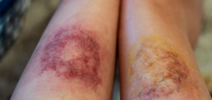 bruises on legs pictures