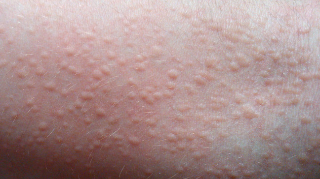 10 Ways To Get Rid Of Heat Rash Fast - HowHunter