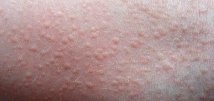 get rid of heat rash