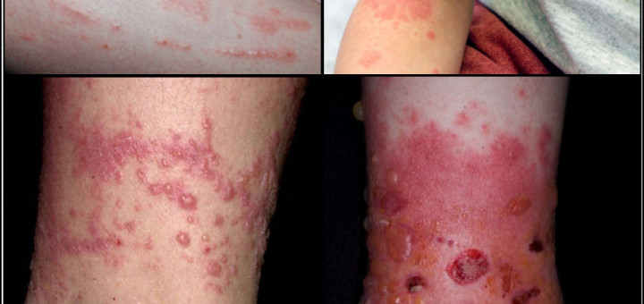 get rid of poison Ivy rash