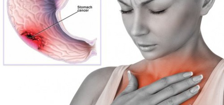 get rid of severe heartburn