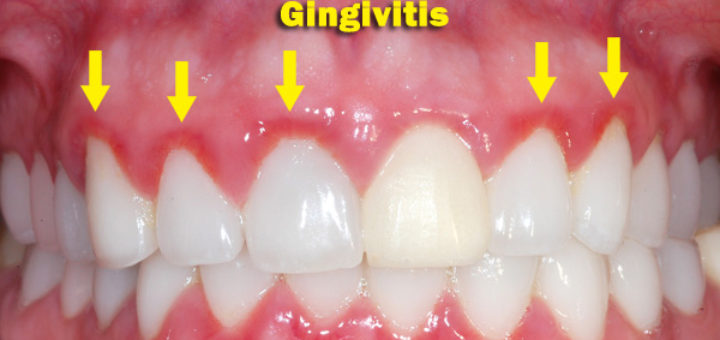 gingivitis