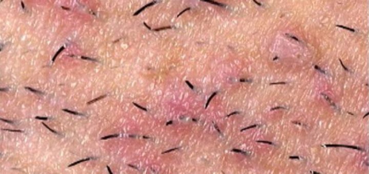 ingrown hairs on face