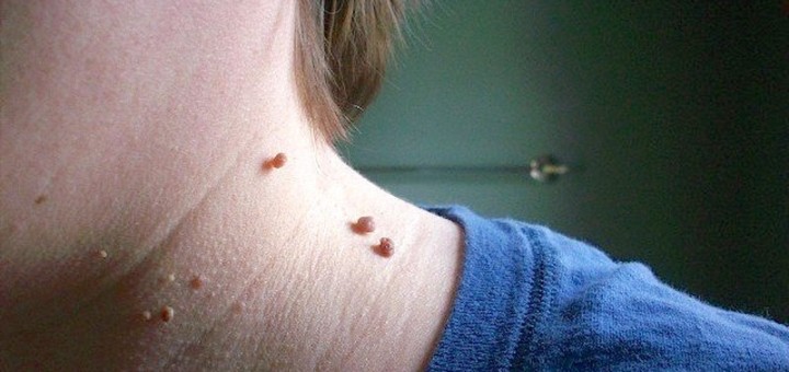 get rid of skin tags