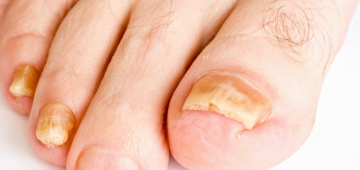 get rid of toenail fungus