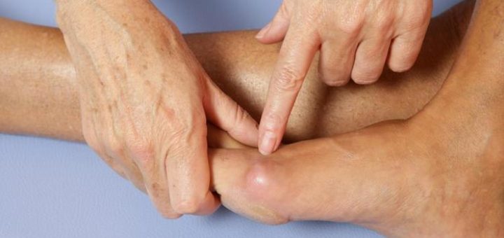 get rid of bunions on foot