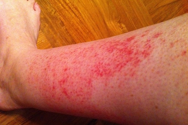 10-ways-to-get-rid-of-rash-on-legs-howhunter