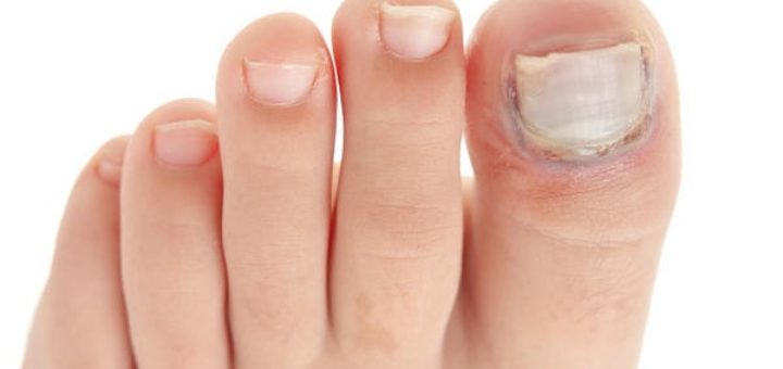 ingrown toenail