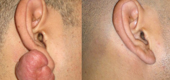 leloids on ear