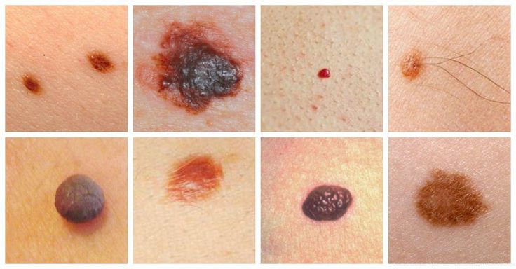 10 Ways To Get Rid of Moles On Skin - HowHunter