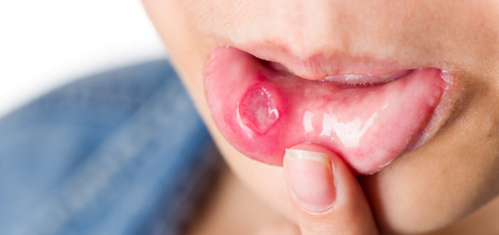 mouth ulcers